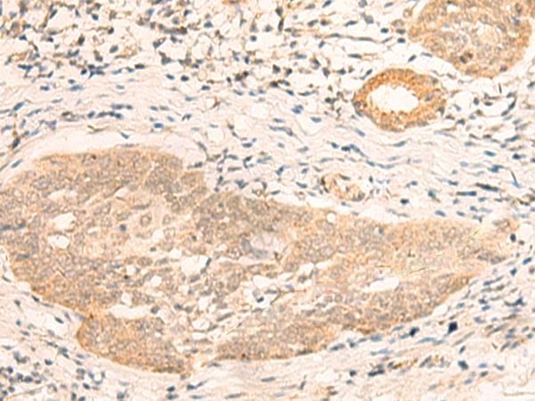 CALCOCO1 / CoCoa Antibody - Immunohistochemistry of paraffin-embedded Human esophagus cancer tissue  using CALCOCO1 Polyclonal Antibody at dilution of 1:40(×200)
