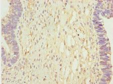 CALCOCO2 Antibody - Immunohistochemistry of paraffin-embedded human ovarian cancer at dilution 1:100