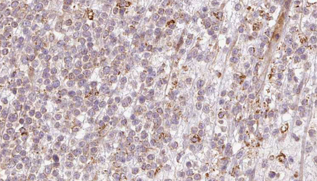 CALCOCO2 Antibody - 1:100 staining human lymph carcinoma tissue by IHC-P. The sample was formaldehyde fixed and a heat mediated antigen retrieval step in citrate buffer was performed. The sample was then blocked and incubated with the antibody for 1.5 hours at 22°C. An HRP conjugated goat anti-rabbit antibody was used as the secondary.