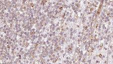 CALCOCO2 Antibody - 1:100 staining human lymph carcinoma tissue by IHC-P. The sample was formaldehyde fixed and a heat mediated antigen retrieval step in citrate buffer was performed. The sample was then blocked and incubated with the antibody for 1.5 hours at 22°C. An HRP conjugated goat anti-rabbit antibody was used as the secondary.