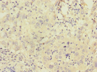 CALCR / Calcitonin Receptor Antibody - Immunohistochemistry of paraffin-embedded human liver cancer at dilution 1:100