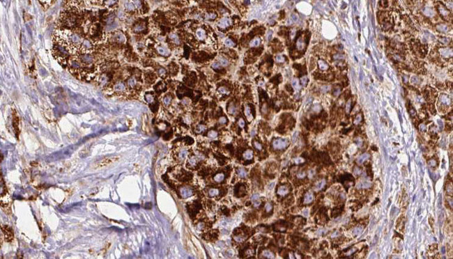 CALCR / Calcitonin Receptor Antibody - 1:100 staining human liver carcinoma tissues by IHC-P. The sample was formaldehyde fixed and a heat mediated antigen retrieval step in citrate buffer was performed. The sample was then blocked and incubated with the antibody for 1.5 hours at 22°C. An HRP conjugated goat anti-rabbit antibody was used as the secondary.