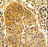 CALD1 / Caldesmon Antibody - Formalin-fixed and paraffin-embedded human lung carcinoma with CALD1 Antibody , which was peroxidase-conjugated to the secondary antibody, followed by DAB staining. This data demonstrates the use of this antibody for immunohistochemistry; clinical relevance has not been evaluated.