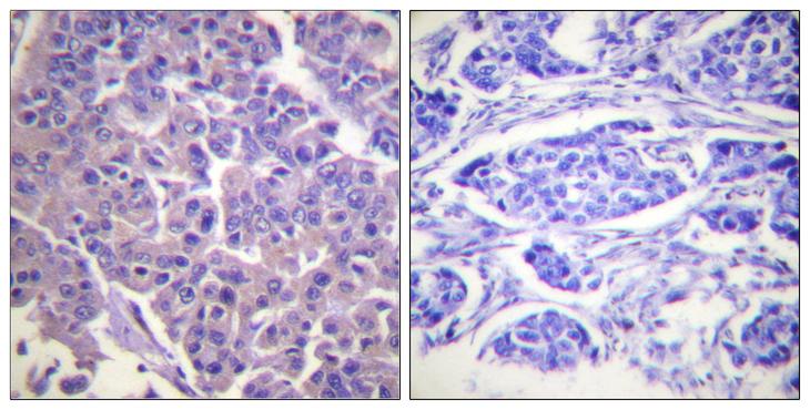 CALD1 / Caldesmon Antibody - Immunohistochemistry analysis of paraffin-embedded human breast carcinoma tissue, using Caldesmon Antibody. The picture on the right is blocked with the synthesized peptide.