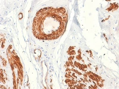 CALD1 / Caldesmon Antibody - Formalin-fixed, paraffin-embedded human Leiomyosarcoma stained with Caldesmon Mouse Recombinant Monoclonal Antibody (rCALD1/820).