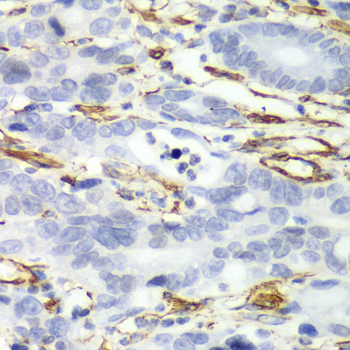 CALD1 / Caldesmon Antibody - Immunohistochemistry of paraffin-embedded human gastric cancer tissue.