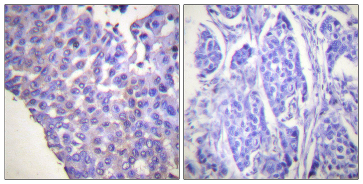 CALD1 / Caldesmon Antibody - Immunohistochemistry analysis of paraffin-embedded human breast carcinoma, using Caldesmon (Phospho-Ser789) Antibody. The picture on the right is blocked with the phospho peptide.
