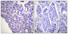 CALD1 / Caldesmon Antibody - P-peptide - + Immunohistochemistry analysis of paraffin-embedded human breast carcinoma tissue using Caldesmon (Phospho-Ser789) antibody.