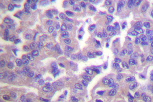 CALD1 / Caldesmon Antibody - IHC of Caldesmon (S783) pAb in paraffin-embedded human breast carcinoma tissue.