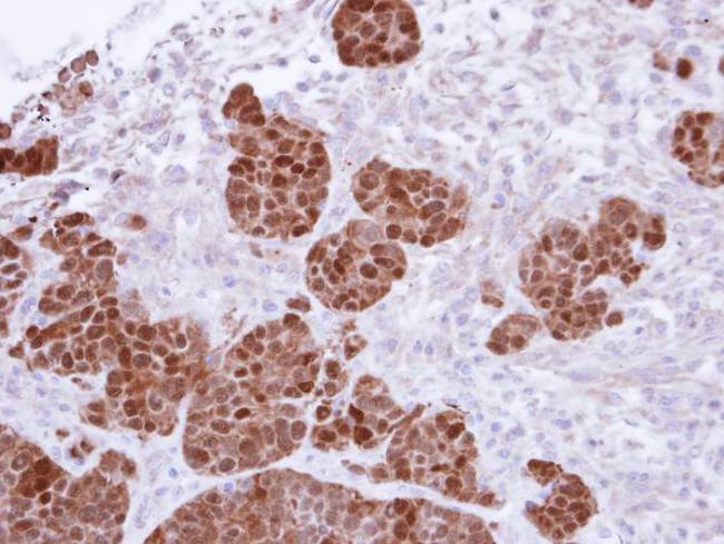 Calgizzarin / S100A11 Antibody - IHC of paraffin-embedded SW480 Xenograft using S100A11 antibody at 1:500 dilution.