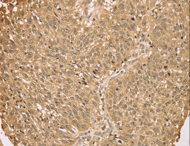 Calgizzarin / S100A11 Antibody - Immunohistochemistry of paraffin-embedded Human lung cancer using S100A11 Polyclonal Antibody at dilution of 1:25.