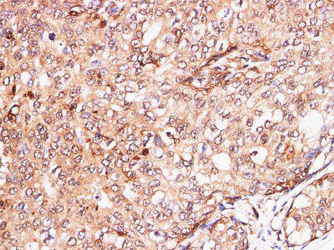 Calgizzarin / S100A11 Antibody - Immunohistochemistry of paraffin-embedded Human breast cancer using S100A11 Polyclonal Antibody at dilution of 1:200.