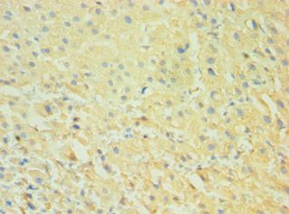 CALHM1 Antibody - Immunohistochemistry of paraffin-embedded human liver cancer using antibody at 1:100 dilution.