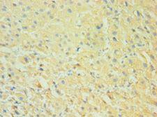 CALHM1 Antibody - Immunohistochemistry of paraffin-embedded human liver cancer using antibody at 1:100 dilution.