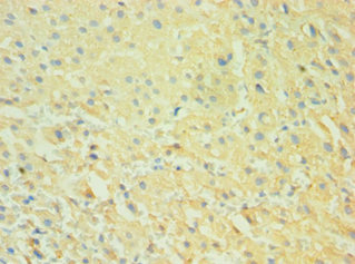 CALHM1 Antibody - Immunohistochemistry of paraffin-embedded human liver cancer using CALHM1 Antibody at dilution of 1:100