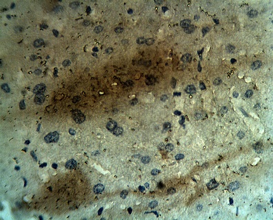 CALHM1 Antibody - Staining on paraffin embedded human hepatocellular carcinoma sections. Primary Ab at 10 ug/ml. Antigen retrieval used: 10 mM Na Citrate pH 6.0, 10 minutes pressure cooker method, developed with anti rabbit HRP and DAP substrate. Counterstained with methyl blue.