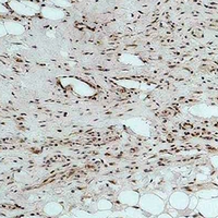 CALHM1 Antibody - Immunohistochemical analysis of CALHM1 staining in human Hepatocarcinoma formalin fixed paraffin embedded tissue section. The section was pre-treated using heat mediated antigen retrieval with sodium citrate buffer (pH 6.0). The section was then incubated with the antibody at room temperature and detected using an HRP conjugated compact polymer system. DAB was used as the chromogen. The section was then counterstained with hematoxylin and mounted with DPX.