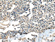 CALHM1 Antibody - Immunohistochemistry of paraffin-embedded Human lung cancer tissue  using CALHM1 Polyclonal Antibody at dilution of 1:60(×200)