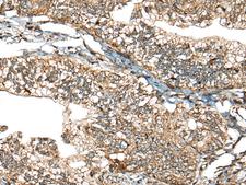 CALHM1 Antibody - Immunohistochemistry of paraffin-embedded Human gastric cancer tissue  using CALHM1 Polyclonal Antibody at dilution of 1:40(×200)