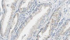 CALM3 / Calmodulin 3 Antibody - 1:100 staining human prostate tissue by IHC-P. The sample was formaldehyde fixed and a heat mediated antigen retrieval step in citrate buffer was performed. The sample was then blocked and incubated with the antibody for 1.5 hours at 22°C. An HRP conjugated goat anti-rabbit antibody was used as the secondary.