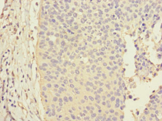 CALML3 Antibody - Immunohistochemistry of paraffin-embedded human cervical cancer at dilution 1:100