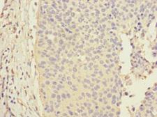 CALML3 Antibody - Immunohistochemistry of paraffin-embedded human cervical cancer at dilution 1:100