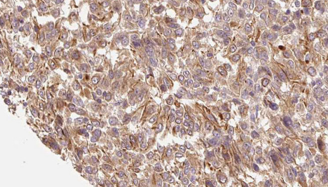 CALML3 Antibody - 1:100 staining human Melanoma tissue by IHC-P. The sample was formaldehyde fixed and a heat mediated antigen retrieval step in citrate buffer was performed. The sample was then blocked and incubated with the antibody for 1.5 hours at 22°C. An HRP conjugated goat anti-rabbit antibody was used as the secondary.