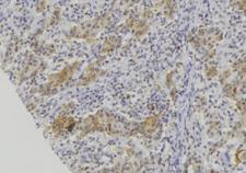 CALML5 Antibody - 1:100 staining human lung carcinoma tissue by IHC-P. The sample was formaldehyde fixed and a heat mediated antigen retrieval step in citrate buffer was performed. The sample was then blocked and incubated with the antibody for 1.5 hours at 22°C. An HRP conjugated goat anti-rabbit antibody was used as the secondary.