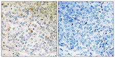 CALML5 Antibody - Peptide - + Immunohistochemistry analysis of paraffin-embedded human breast carcinoma tissue using CALML5 antibody.
