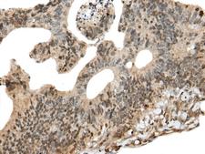 CALML5 Antibody - Immunohistochemistry of paraffin-embedded Human colorectal cancer tissue  using CALML5 Polyclonal Antibody at dilution of 1:90(×200)