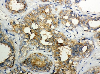 Calpain Antibody - IHC-P: Calpain 1 antibody testing of human breast cancer tissue