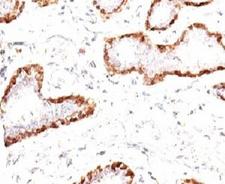 Calponin Antibody - Formalin-fixed, paraffin-embedded human breast carcinoma stained with anti-Calponin antibody (CNN1/832).  This image was taken for the unmodified form of this product. Other forms have not been tested.