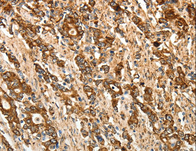CALR / Calreticulin Antibody - Immunohistochemistry of paraffin-embedded Human gastric cancer using CALR Polyclonal Antibody at dilution of 1:50.