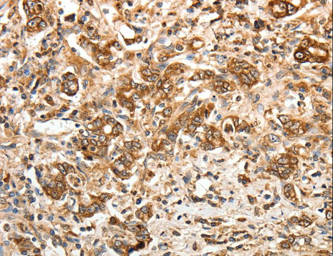 CALR / Calreticulin Antibody - Immunohistochemistry of paraffin-embedded Human gastric cancer using CALR Polyclonal Antibody at dilution of 1:30.