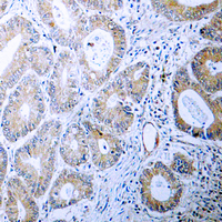 CALR / Calreticulin Antibody - Immunohistochemical analysis of Calreticulin staining in human colon cancer formalin fixed paraffin embedded tissue section. The section was pre-treated using heat mediated antigen retrieval with sodium citrate buffer (pH 6.0). The section was then incubated with the antibody at room temperature and detected using an HRP conjugated compact polymer system. DAB was used as the chromogen. The section was then counterstained with hematoxylin and mounted with DPX.