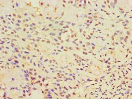 CALR3 Antibody - Immunohistochemistry of paraffin-embedded human breast cancer using antibody at 1:100 dilution.
