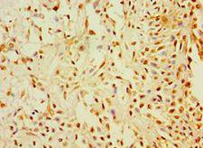 CALR3 Antibody - Immunohistochemistry of paraffin-embedded human breast cancer using antibody at 1:100 dilution.