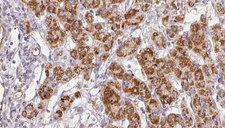 CALY Antibody - 1:100 staining human liver carcinoma tissues by IHC-P. The sample was formaldehyde fixed and a heat mediated antigen retrieval step in citrate buffer was performed. The sample was then blocked and incubated with the antibody for 1.5 hours at 22°C. An HRP conjugated goat anti-rabbit antibody was used as the secondary.