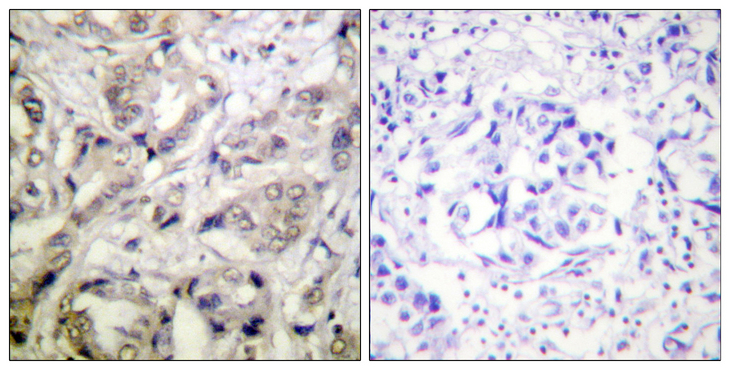 CAMK1 / CAMKI Antibody - Immunohistochemistry analysis of paraffin-embedded human breast carcinoma tissue, using CaMK1-alpha Antibody. The picture on the right is blocked with the synthesized peptide.