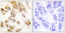 CAMK1 / CAMKI Antibody - Immunohistochemistry analysis of paraffin-embedded human breast carcinoma, using CaMK1-alpha (Phospho-Thr177) Antibody. The picture on the right is blocked with the phospho peptide.