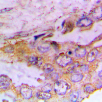 CAMK1 / CAMKI Antibody - Immunohistochemical analysis of CaMK1 alpha (pT177) staining in human lung cancer formalin fixed paraffin embedded tissue section. The section was pre-treated using heat mediated antigen retrieval with sodium citrate buffer (pH 6.0). The section was then incubated with the antibody at room temperature and detected using an HRP conjugated compact polymer system. DAB was used as the chromogen. The section was then counterstained with hematoxylin and mounted with DPX. w