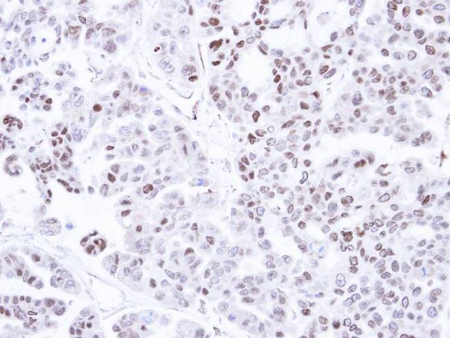 CAMK1D Antibody - IHC of paraffin-embedded OVCAR3 xenograft using CAMK1D antibody at 1:500 dilution.