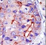 CAMK1D Antibody - Formalin-fixed and paraffin-embedded human cancer tissue reacted with the primary antibody, which was peroxidase-conjugated to the secondary antibody, followed by DAB staining. This data demonstrates the use of this antibody for immunohistochemistry; clinical relevance has not been evaluated. BC = breast carcinoma; HC = hepatocarcinoma.