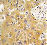 CAMK1D Antibody - Formalin-fixed and paraffin-embedded human hepatocarcinoma tissue reacted with CAMK1-like Antibody , which was peroxidase-conjugated to the secondary antibody, followed by DAB staining. This data demonstrates the use of this antibody for immunohistochemistry; clinical relevance has not been evaluated.