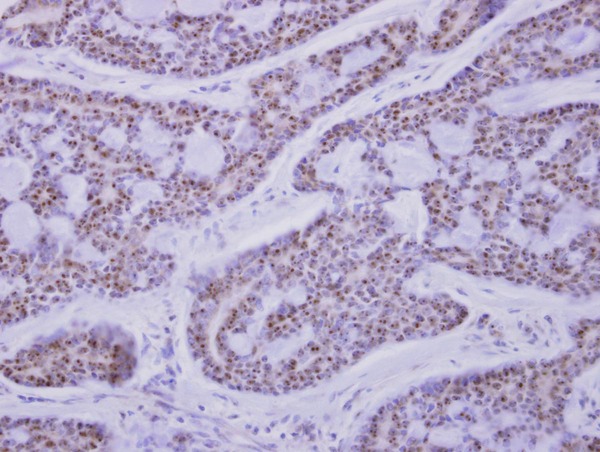 CAMK1D Antibody - CaMK1D antibody detects CAMK1D protein at nucleus on breast carcinoma by immunohistochemical analysis. Sample: Paraffin-embedded breast carcinoma. CaMK1D antibody dilution:1:500.