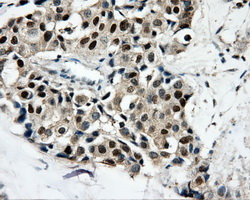 CAMK1D Antibody - IHC of paraffin-embedded Adenocarcinoma of breast tissue using anti-CAMK1D mouse monoclonal antibody. (Dilution 1:50).