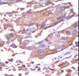 CAMK2A / CaMKII Alpha Antibody - Formalin-fixed and paraffin-embedded human cancer tissue reacted with the primary antibody, which was peroxidase-conjugated to the secondary antibody, followed by AEC staining. This data demonstrates the use of this antibody for immunohistochemistry; clinical relevance has not been evaluated. BC = breast carcinoma; HC = hepatocarcinoma.