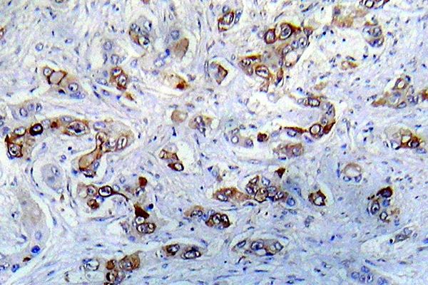 CAMK2A / CaMKII Alpha Antibody - IHC of CaMK2-a (K292) pAb in paraffin-embedded human A431 tissue.
