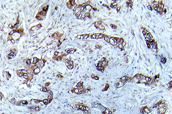 CAMK2A / CaMKII Alpha Antibody - IHC of p-CaMK2-a (T286) pAb in paraffin-embedded human breast carcinoma tissue.