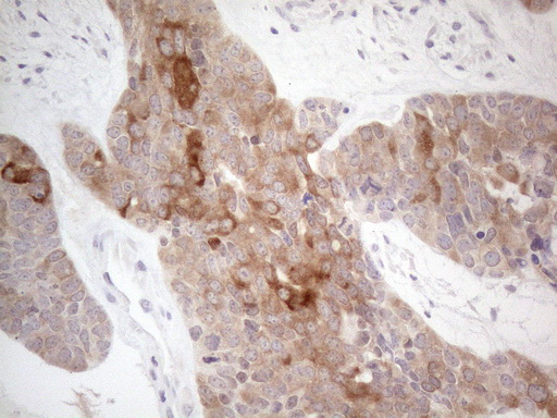 CAMK2B / CaMKII Beta Antibody - Immunohistochemical staining of paraffin-embedded Adenocarcinoma of Human endometrium tissue using anti-CAMK2B mouse monoclonal antibody. (Heat-induced epitope retrieval by 1mM EDTA in 10mM Tris buffer. (pH8.5) at 120°C for 3 min. (1:150)